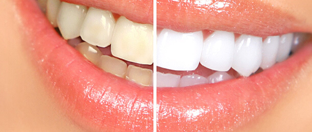 before and after teeeth whitening