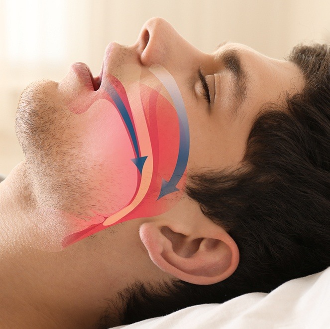 Sleeping man with animated airway over his profile