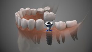 Rendering of a dental implant in a translucent lower jaw