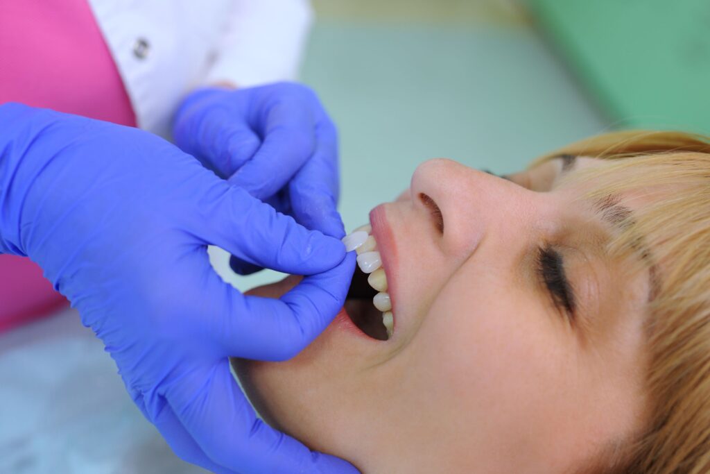 Closeup of blue-gloved hands placing veneers on woman's upper teeth